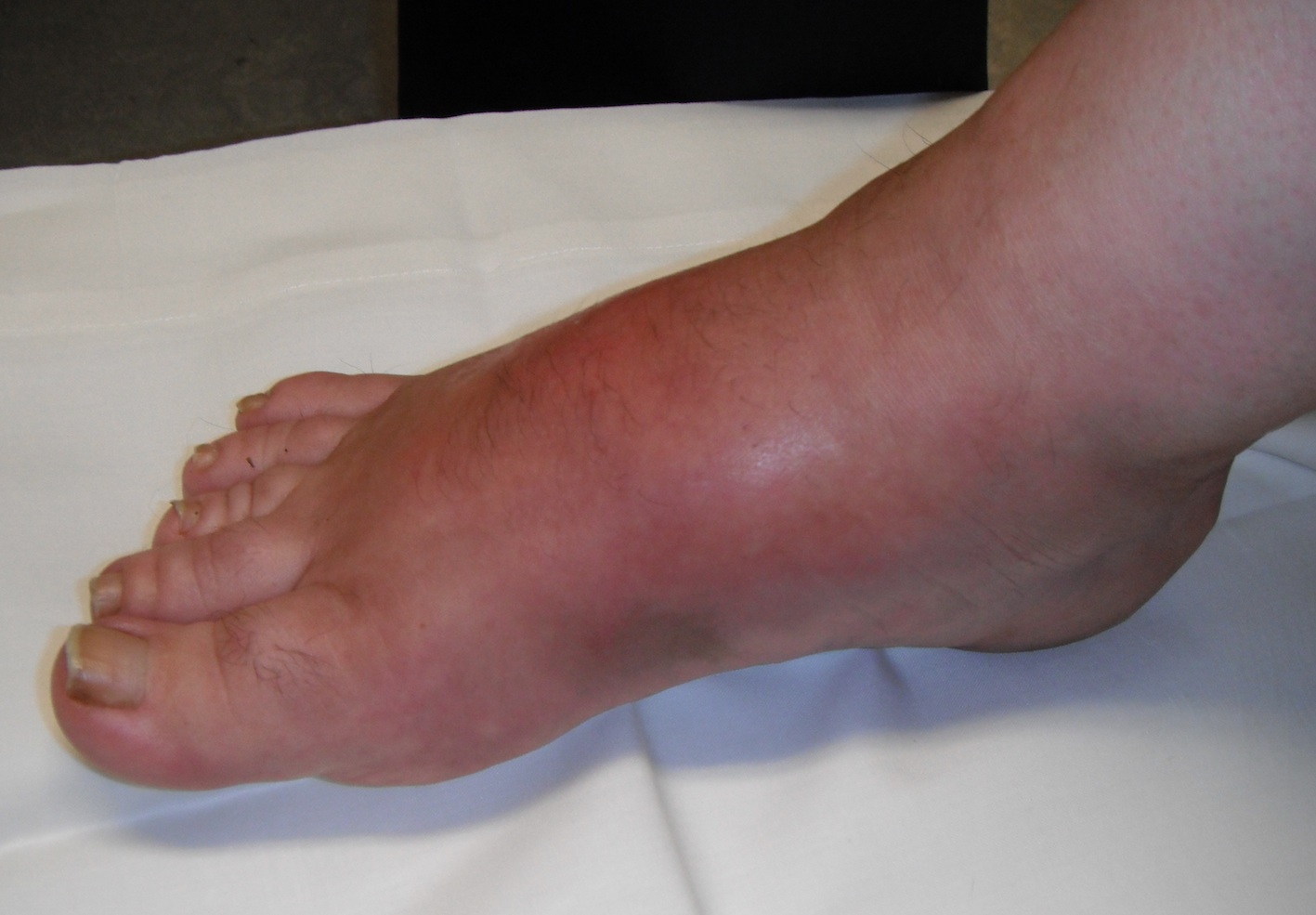 Charcot Foot